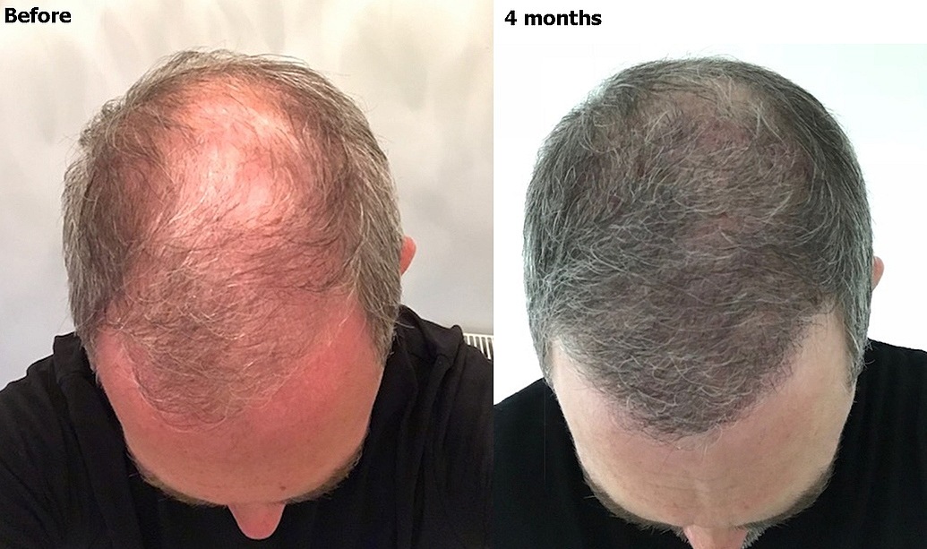 PP405 Hair Treatment